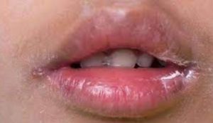 راهنمایی استفاده از روغن‌های طبیعی در درمان قارچ لب