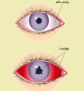 درمان خانگی برای بیماری یوئیت چشم