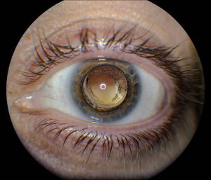 میدریازیس یعنی چه؟