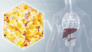 ۷ روش درمانی خانگی برای کبد چرب غیر الکلی