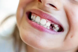 درمان‌های موثر برای دندان‌های شکسته
